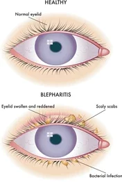 Blepharitis