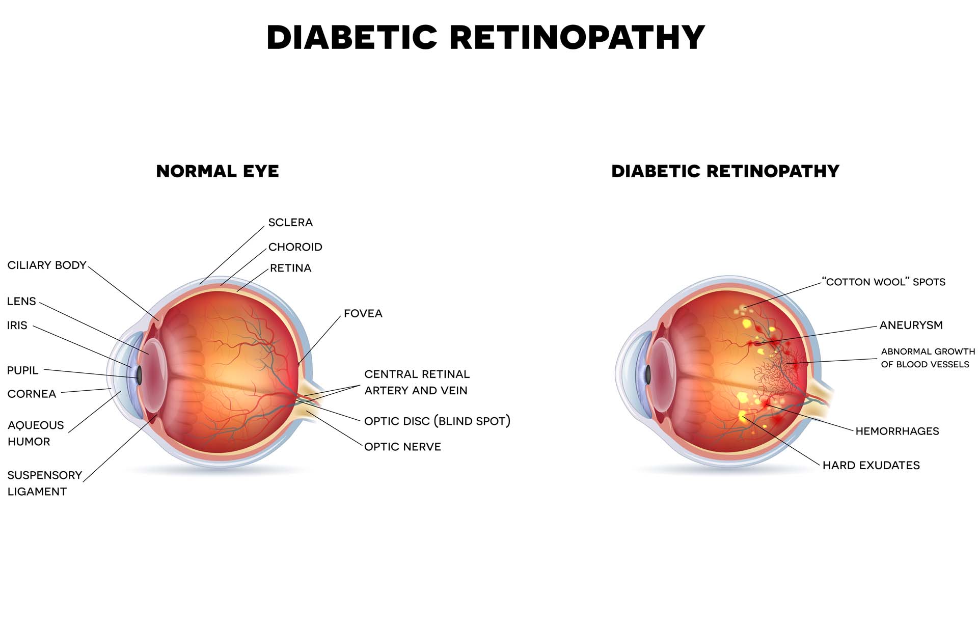 Diabetic retinopathy and healthy eye anatomy