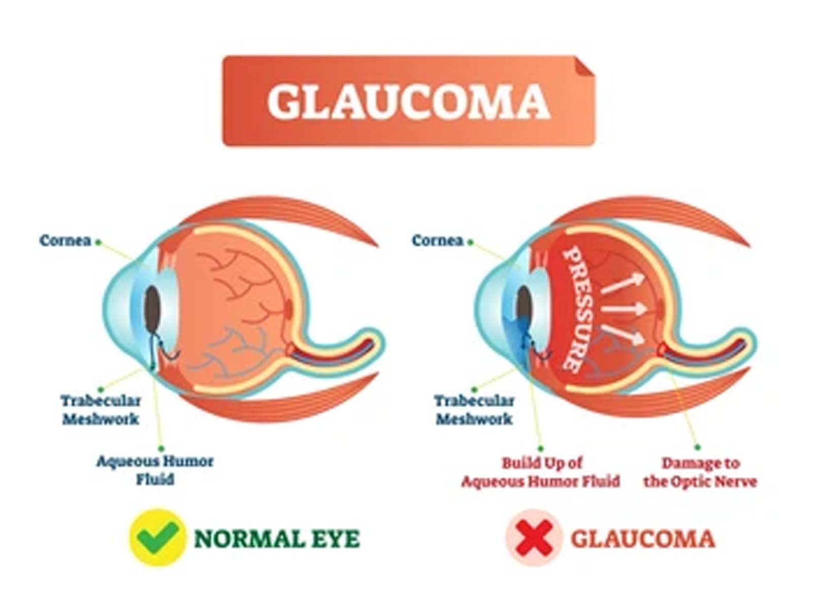 Glaucoma