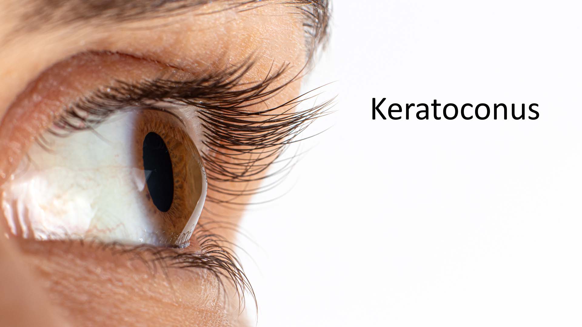 Keratoconus - eye disease,