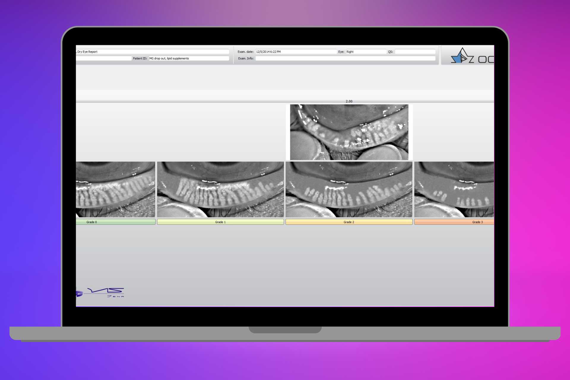 Meibomian gland dysfunction computer view