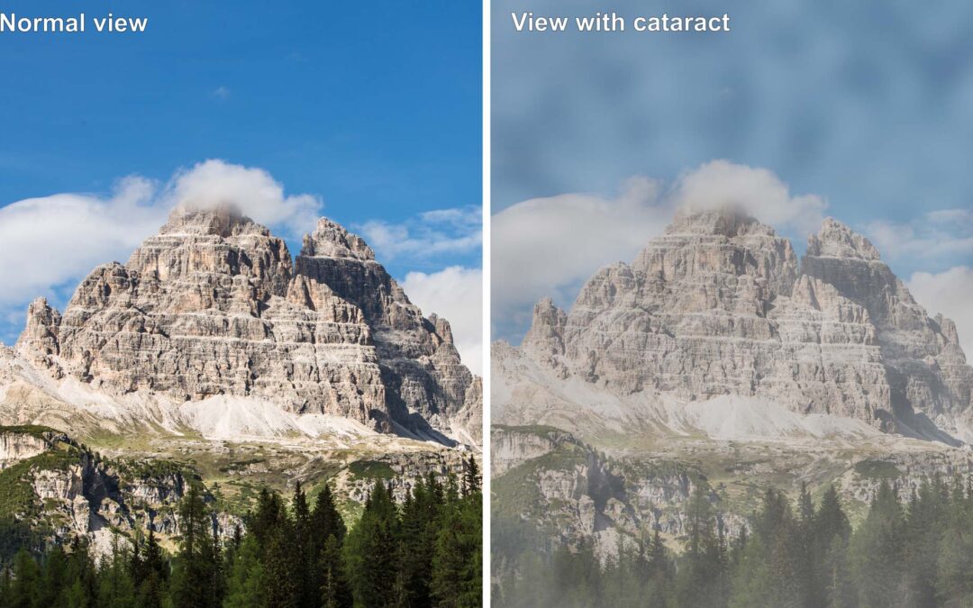 Comparison between a normal view and view of patient suffering from cataract